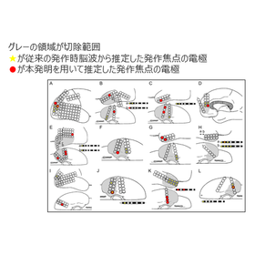 東北大学技術：てんかん原性領域の推定プログラム：T21-359