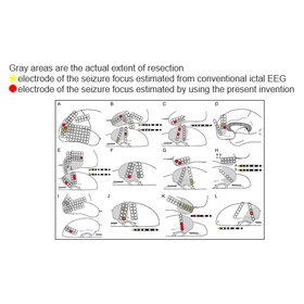 Tohoku Univ. Technology ：Epileptogenic domain estimation program：T21-359