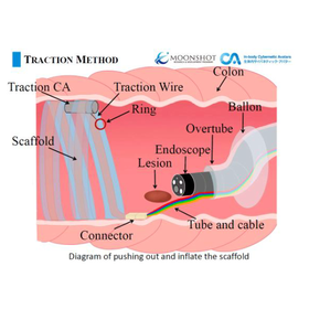 東北大学技術：内視鏡治療用牽引システム：T24-072 製品画像