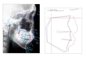 セファロ分析・画像管理プログラム『WinCeph Ver.11』